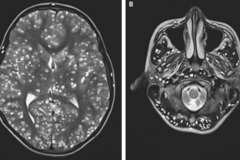 Científicos advierten sobre lesiones cerebrales relacionadas al COVID-19. Noticias en tiempo real