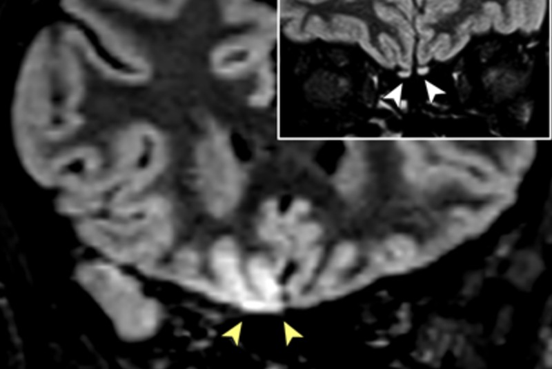 Resonancia magnética a paciente con Covid-19 revela signos de “invasión cerebral viral”. Noticias en tiempo real