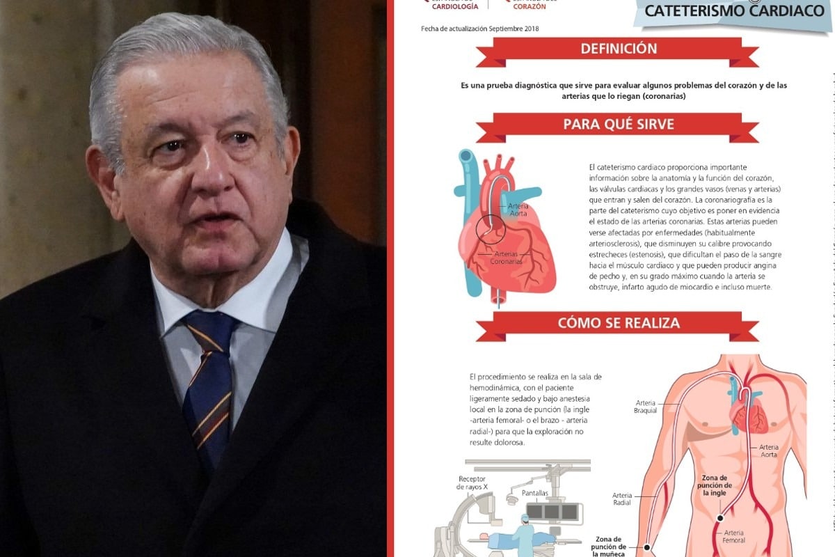 ¿Qué es el cateterismo cardíaco realizado al presidente López Obrador?. Noticias en tiempo real