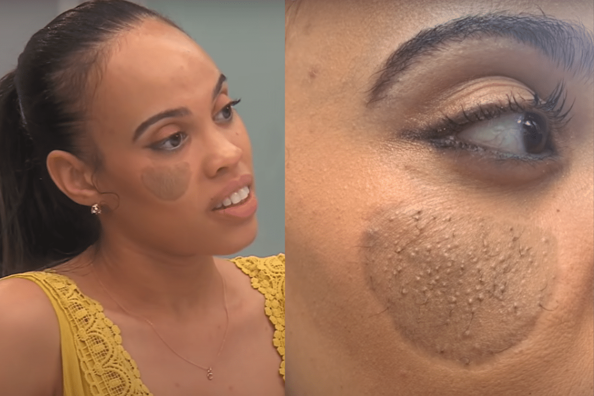 Foto: YouTube/ E! Entertainment | Mujer recibe injerto de piel en el rostro, ahora le crece vello púbico