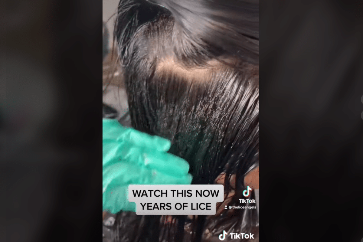Foto: TikTok / @theliceangels | VIDEO: Experta en remover piojos comparte el peor caso que ha visto ¡¡5 años sin tratamiento!!