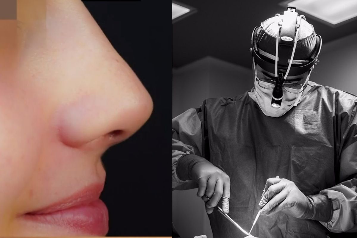 Foto:Instagram/@raul_lopezinfanteysaldaña|Rinoseptoplastia Integral: La cirugía estética y funcional de la nariz