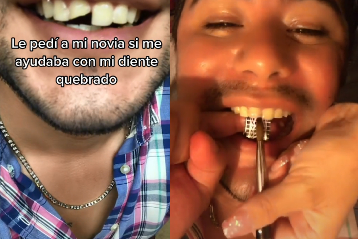 Joven le pidió ayuda a su novia manicurista antes que aun odontólogo, para que le reparará su diente roto
