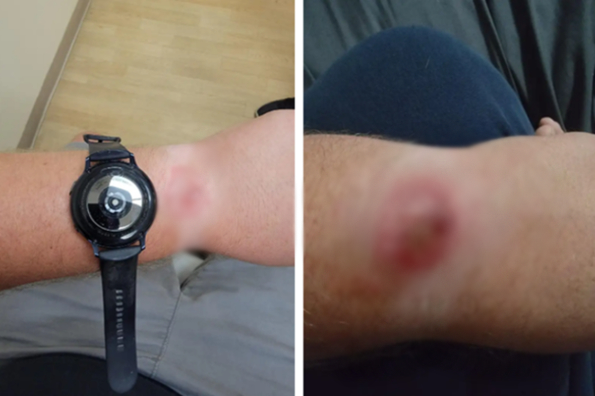 En redes un hombre aseguró que su Samsung Galaxy Watch Active 2, le causó  quemaduras en su muñeca, derivado al sobrecalentamiento de este