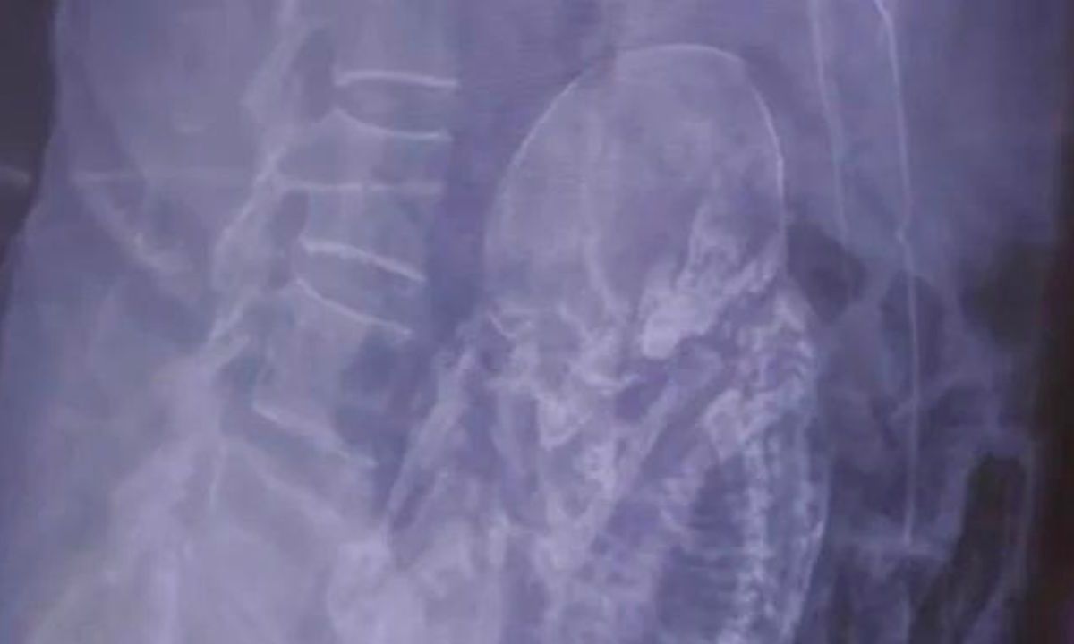 Abuelita de más de 80 años va al hospital por molestias; le hallan feto de 40 años fuera del útero.