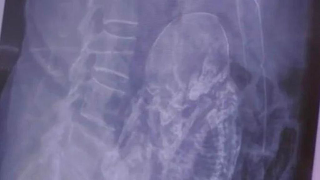 Abuelita de más de 80 años va al hospital por molestias; le hallan feto de 40 años fuera del útero.