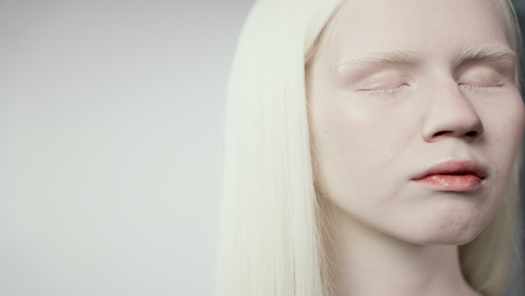 imagen de una mujer con albinismo