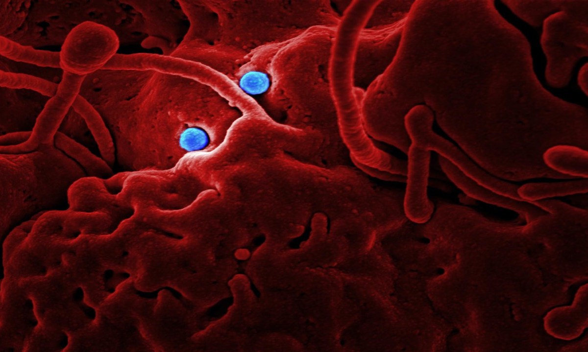 imagen representativa de la sepsis