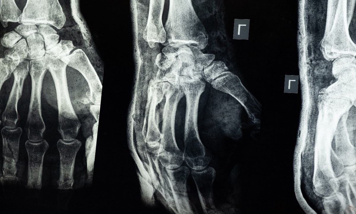 radiografía de huesos