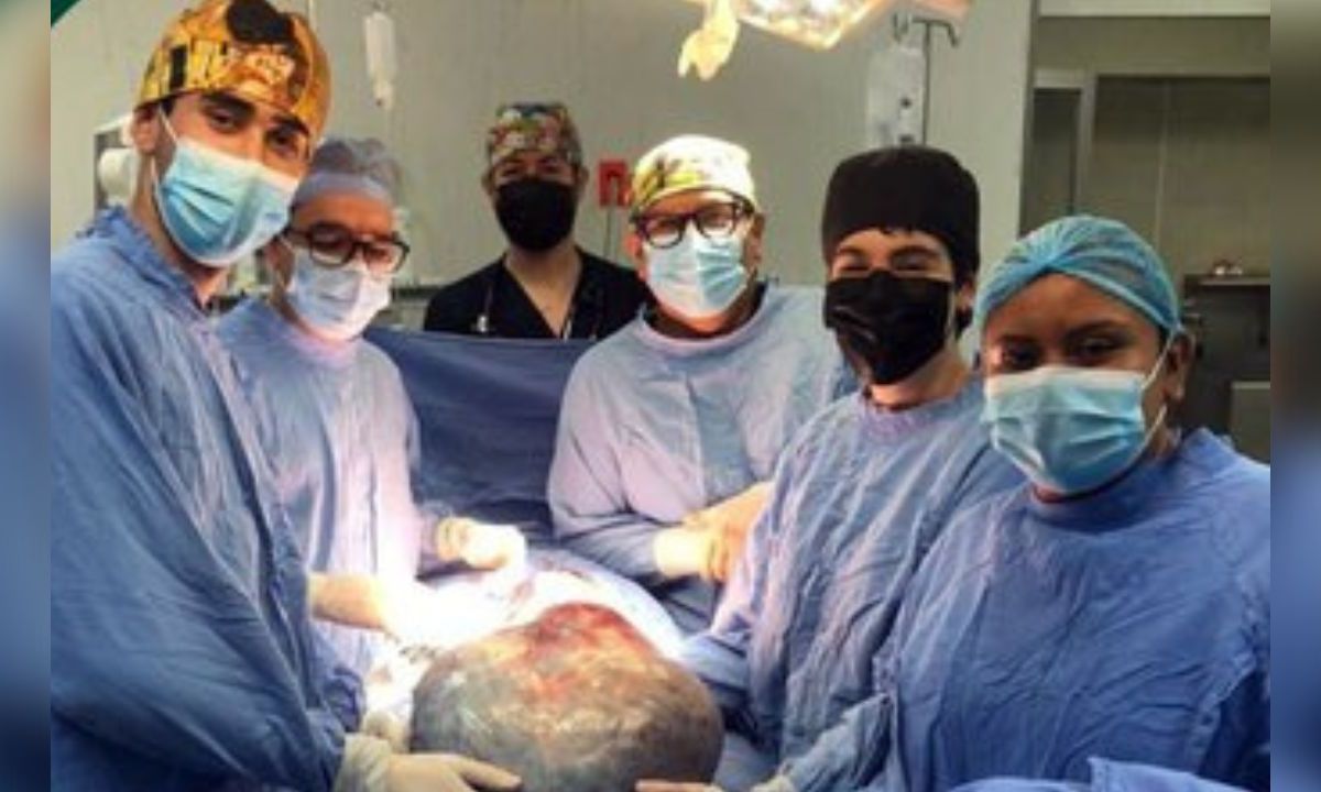 ¡Increíble! Retiran tumor ovárico de 21 kilos a adulta mayor en el IMSS