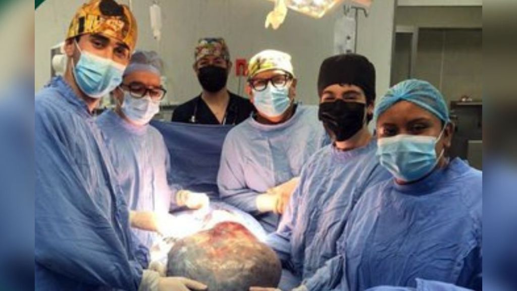 ¡Increíble! Retiran tumor ovárico de 21 kilos a adulta mayor en el IMSS